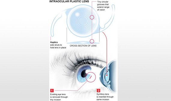 عدسة طبية تحل مشاكل الرؤية المتعددة