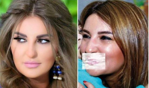 بالصور: ماذا حصل بشفاه شذى حسّون؟