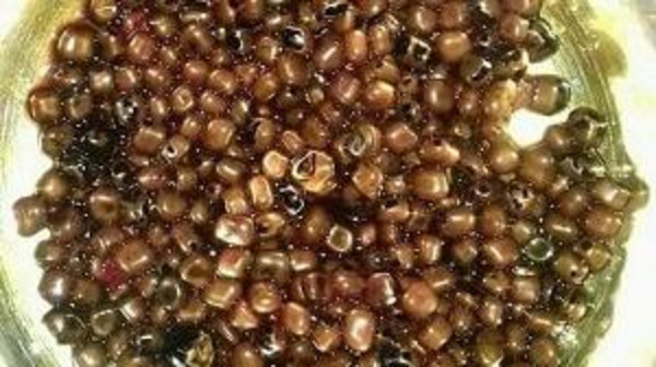 استخراج 475 حصاة من مرارة سيدة مصرية