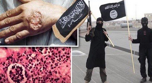 إصابة آلاف من تنظيم "داعش" بمرض طفيلي يؤدي لتآكل لحومهم