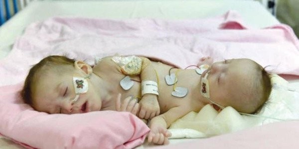 عودة الطفلة السيامي حنين إلى غزة