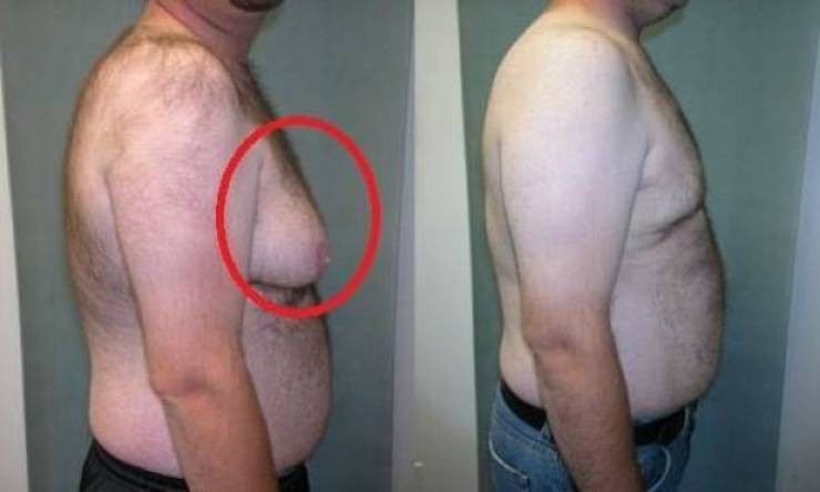 تحذيرٌ مما يصيب الرجال.. تعرف على هذا المرض!