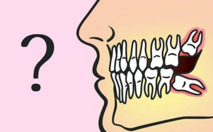إقرأ قبل أن تُقرر خلع 'ضرس العقل'