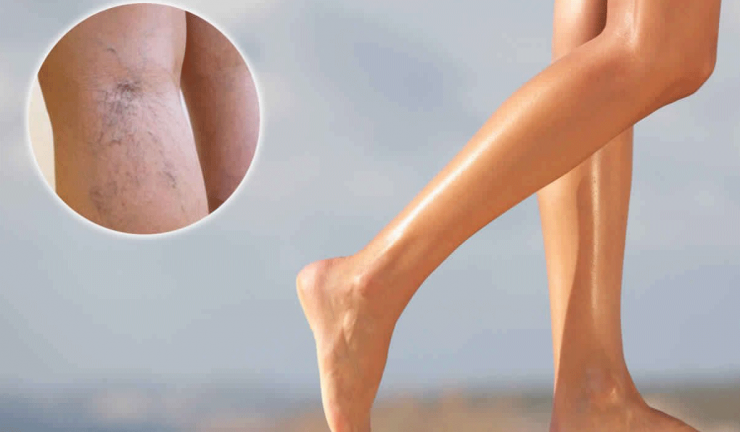 احذروا .. دوالي الساقين قد تصل لحد الموت!