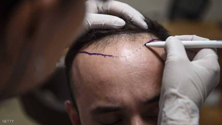 للرجال الصلع.. نمو الشعر بات ممكنا في 6 أيام