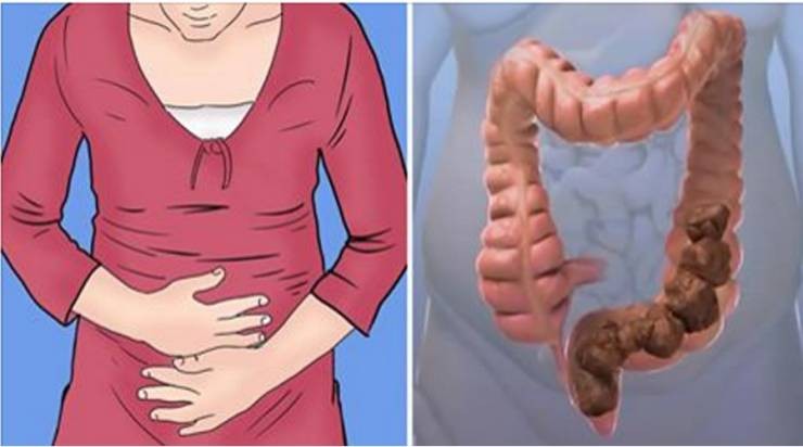 معلومات مهمّة عن الإمساك.. متى تحتاج لاستشارة الطبيب؟