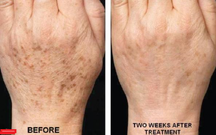 حيلة طبيعية لمكافحة الكلف والبقع البنية