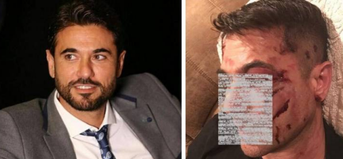 شاهد : أحمد عز يفاجئ الجميع بوجهه المشوّه.. وما حقيقه تعرضه لحادث؟