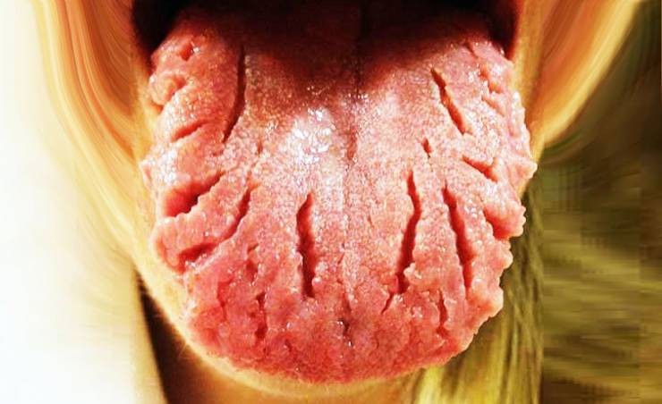 اهم 10 طرق طبيعية منزلية لعلاج تشقق اللسان