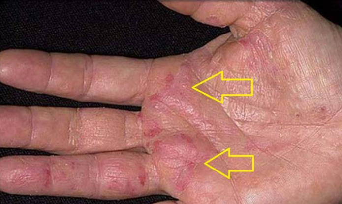 العوارض الأولى للسرطان تظهر على اليدين! كيف تكتشفونها ؟
