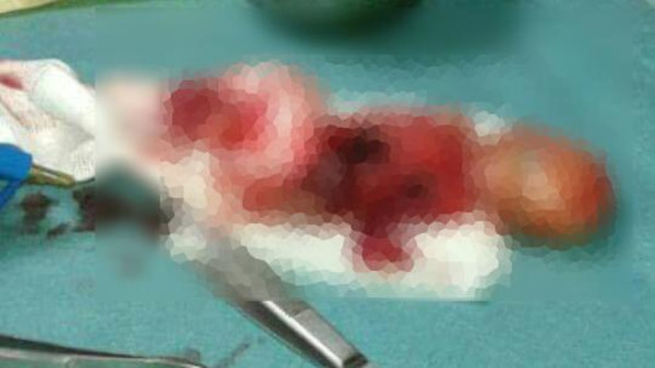 سيدة سورية تفقد جنينها بعد استهداف منزلها شرق حلب