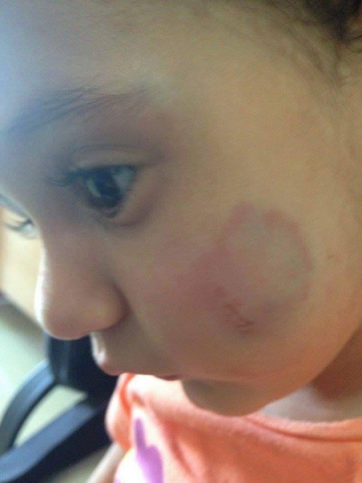 طفلة تعرضت للضرب والعض في أحد الحضانات في رام الله تثير الجدل على وسائل التواصل الاجتماعي