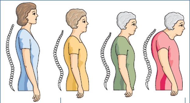 3 أطعمة مهمة تقيك من هشاشة العظام