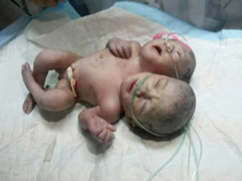 وفاة التوأم السيامي المولود بجسم واحد في غزة