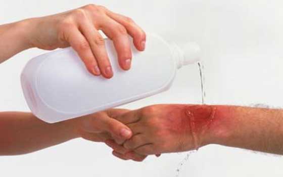 خطوات لعلاج الحروق