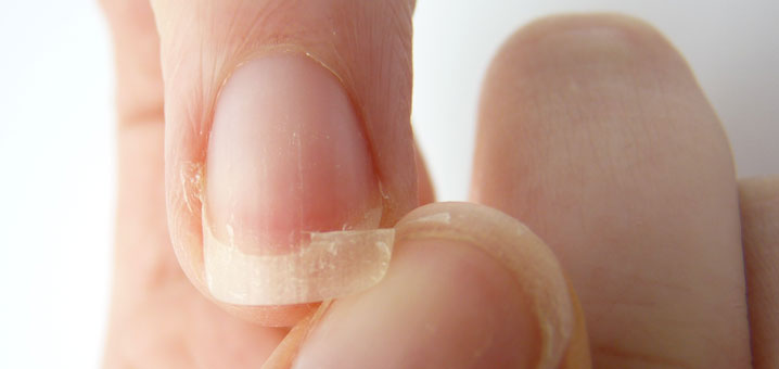 تعرفوا عليها : 18 علامة تدلّ على نقص في الحديد