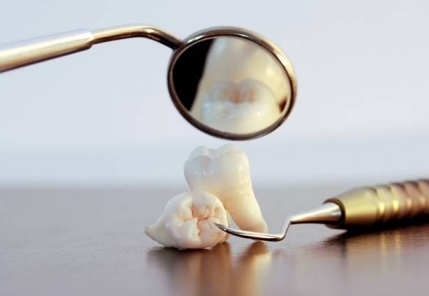 لماذا نسميه "ضرس العقل".. وهل يجب خلعه؟