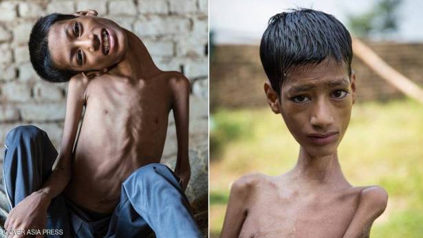 جراحة نادرة تنقذ الطفل صاحب "الرقبة الملتوية"