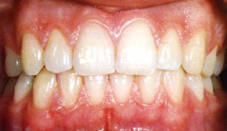 هذه العلاجات تخلّصكم من تورّم اللثة.. جرّبوها!