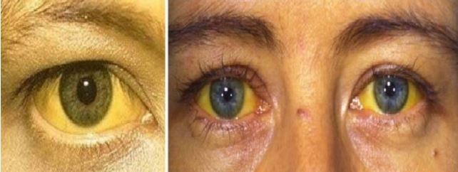 أخطر ممّا تظن.. تعرف على المشاكل الصحية وراء إصفرار العين!