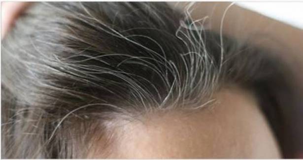 لماذا يظهر الشعر الابيض فى رأس شباب لم يتخطوا الثلاثين من عمرهم؟