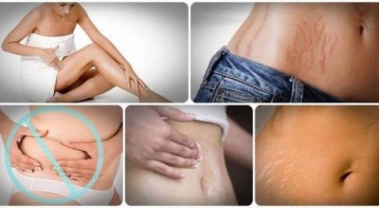 هام جداً : تخلصوا من علامات تمدد الجلد بهذه الوصفات الطبيعية!