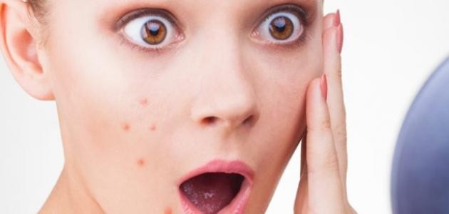 أسباب غير متوقعة لظهور الحبوب في البشرة