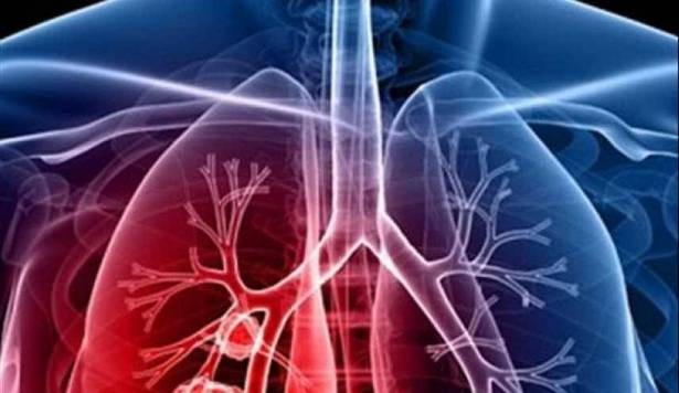 دراسة: مرضى سرطان الرئة لديهم ميول انتحارية أكثر من غيرهم !