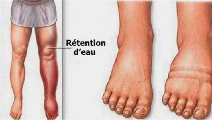 وصفة طبيعية لعلاج مشكلة احتباس الماء في الجسم!