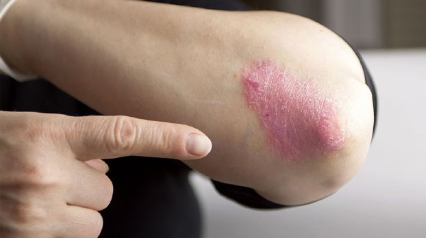 شاهدوا : مرضى الصدفية أكثر عرضة للنوبات القلبية والوفاة