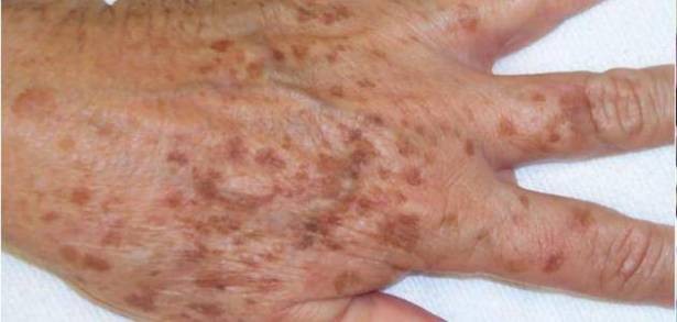 إليكم طريقة سحرية لتتخلصوا من بقع الجلد البنية المحرجة!