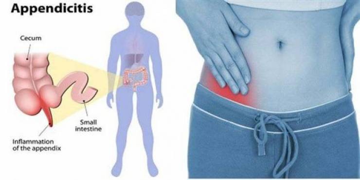 إلتهاب الزّائدة الدوديّة : الأعراض والعلامات وأهمّيّة التدخّل المبكّر