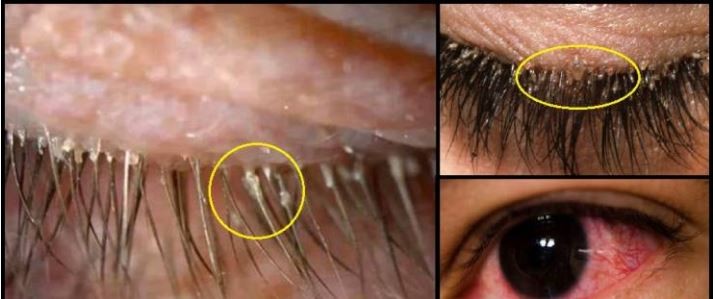 كانت تعاني من حكة شديدة في عينيها و ما وجدته بين رموشها أرعب الأطباء!