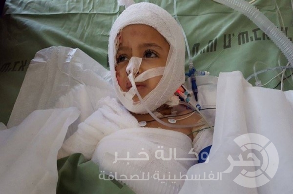 تحسن على صحة الطفل دوابشة: لماذا أنا محروق؟