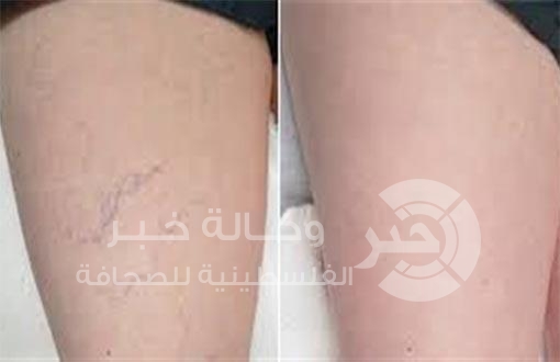 وصفة طبيعية للتخلص من دوالي الساقين دون أدوية