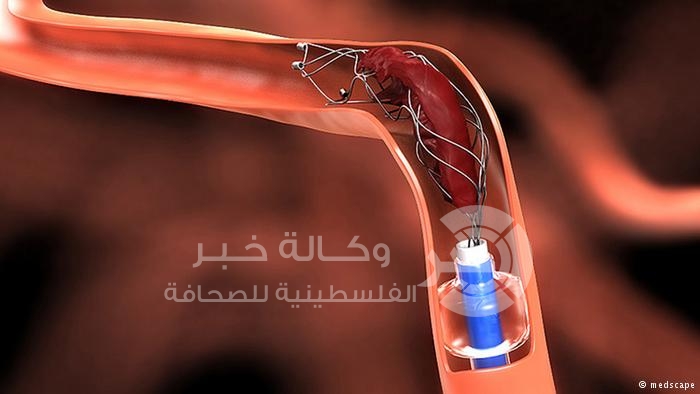 "اصطياد" الجلطة- طريقة مبتكرة لعلاج السكتة الدماغية