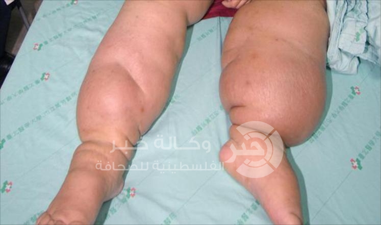 انتفاخ القدمين ينذر بوجود أمراض خطيرة