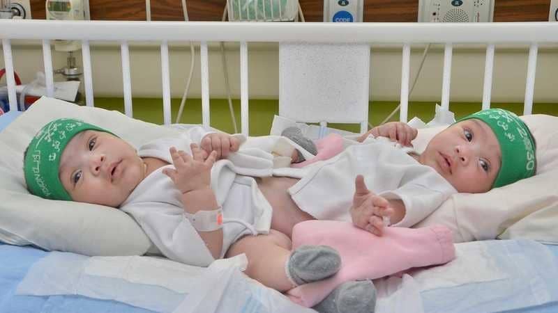 فريق طبي سعودي يجري العملية 46 لفصل توأم سيامي